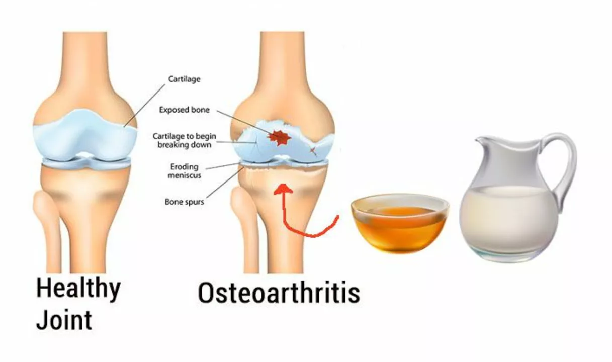 The Impact of Osteoarthritis on Quality of Life: Strategies for Coping